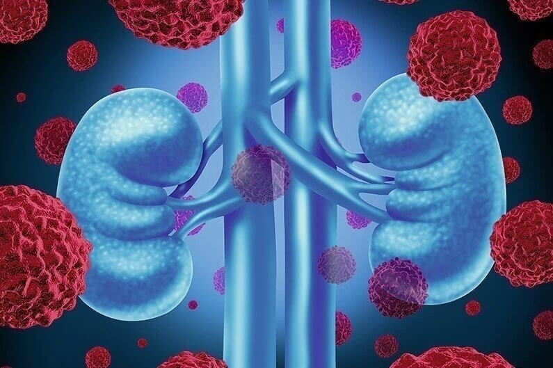 Kidney cancer medical concept as cancerouse cells in a human body attacking the urinary system and renal anatomy as a symbol for tumor growth treatment and risk.