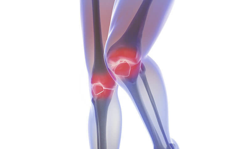 Arthrose Knie
