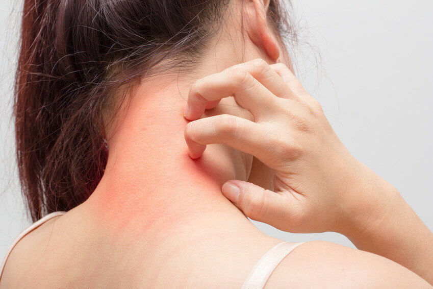 Women scratch the itch with hand ,neck, itching, Concept with Healthcare And Medicine.