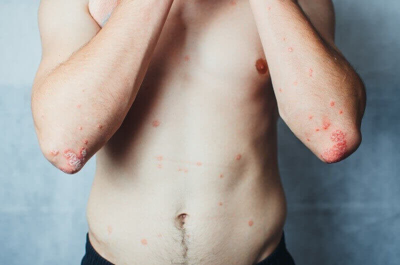 on the Elbows Psoriasis