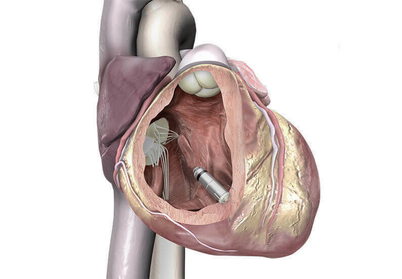 Minischrittmacher Micra in heart