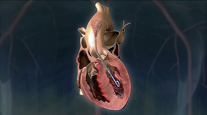 Herzpumpe Herz