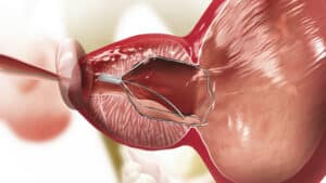 Prostata iTind Prodecural Steps Expanded 72789 Prostata iTind Prodecural Steps Expanded 72789