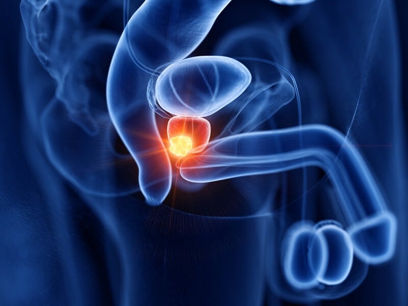 Prostatakrebs Bild AdobeStock Urheber SciePro
