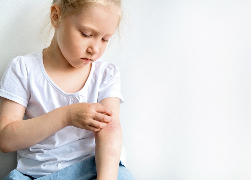 Kind mit Neurodermitis kratzt sich am Arm