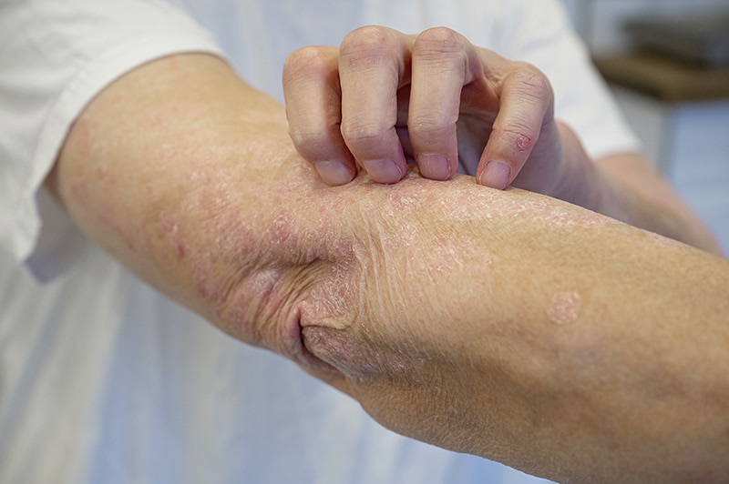 Itchy psoriasis on arm and hand