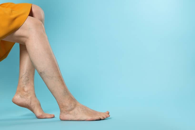 Closeup view of woman with varicose veins on light blue background. Space for text