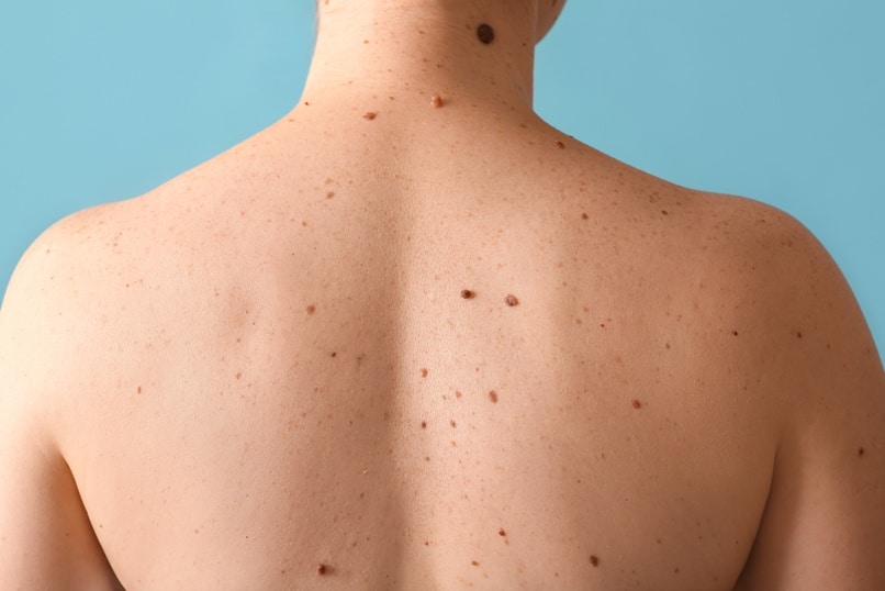 Woman with moles on her back against blue background, closeup