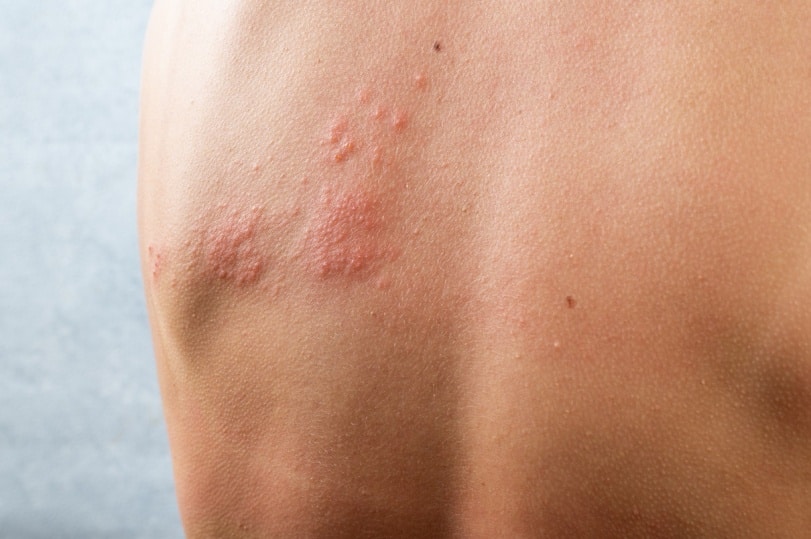 chickenpox rash. Shingles, varicella-zoster virus. skin rash and blisters on body. Skin infected Herpes zoster virus. Herpes Virus on body. urticaria rash. atopic dermatitis.