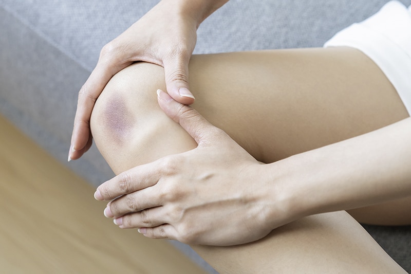 Close up of stain bruise wound on leg, contusion asian young woman, girl on joint knee from an accident fell down, hand in healing injury by massage hematoma blood. Extravasation blue, purple on skin.