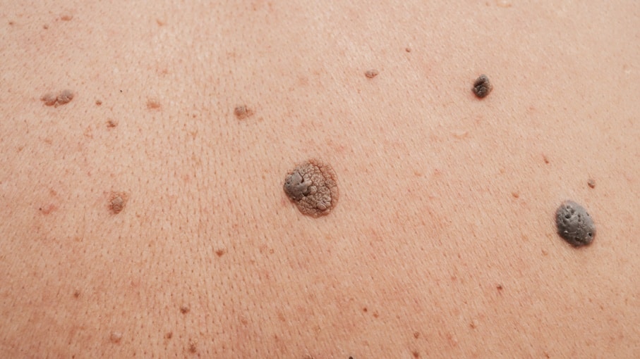 Human skin with freckles, aging sports, black and brown males warts, wrinkles