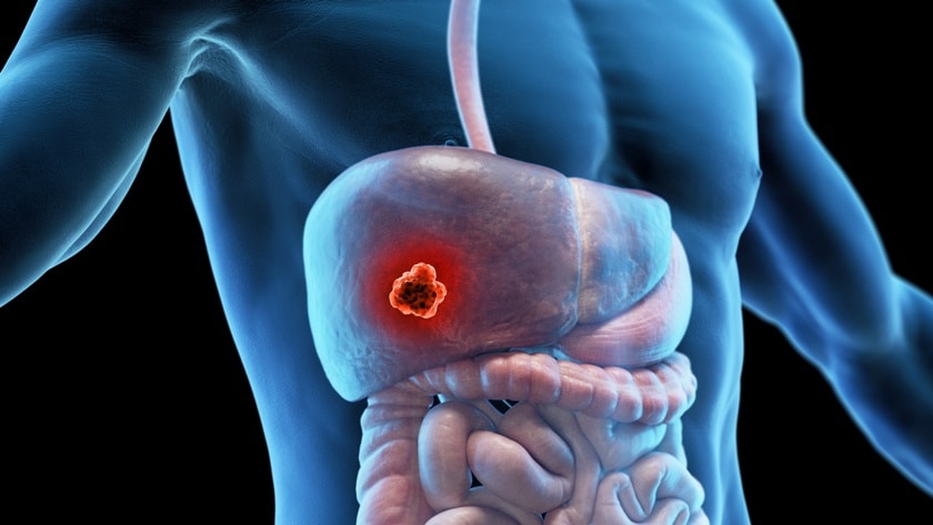 3d medical illustration of liver cancer