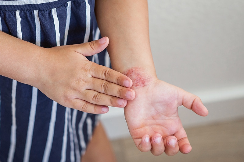 Close-up of child s hands with red irritated skin atopic dermatitis on the wrist, showing symptoms allergy, inflammation, sensitivity, highlighting dermatological problems and need for skin treatment