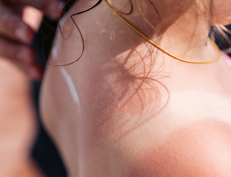 father apply sun protection cream on his daughter's burnt back on a hot summer sunny day