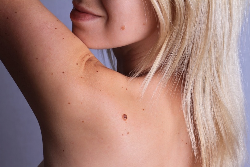 Checking benign moles : Woman with birthmarks on her back and face